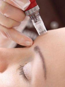 Microneedling vs DermaRoller